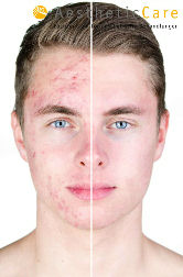 Hautsache Miltenberg Akne und Hautunreinheiten
