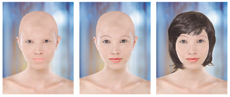 Komplettpigmentierung; Alopecia totalis
